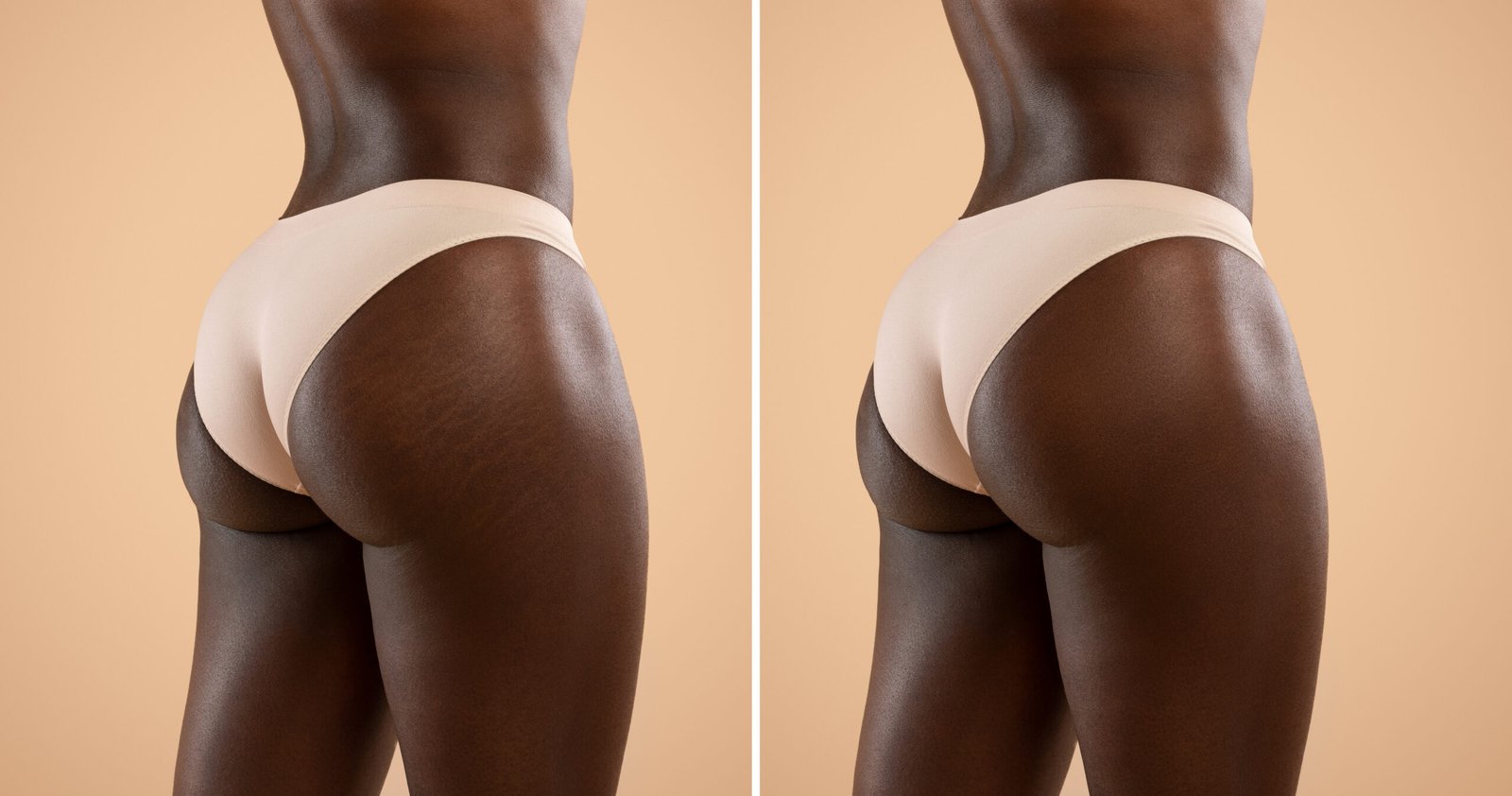 Collage for before and after massage, liposuction, soothing beauty products using results concept, unrecognizable black woman showing her buttocks with and without stretch marks, two shots, panorama